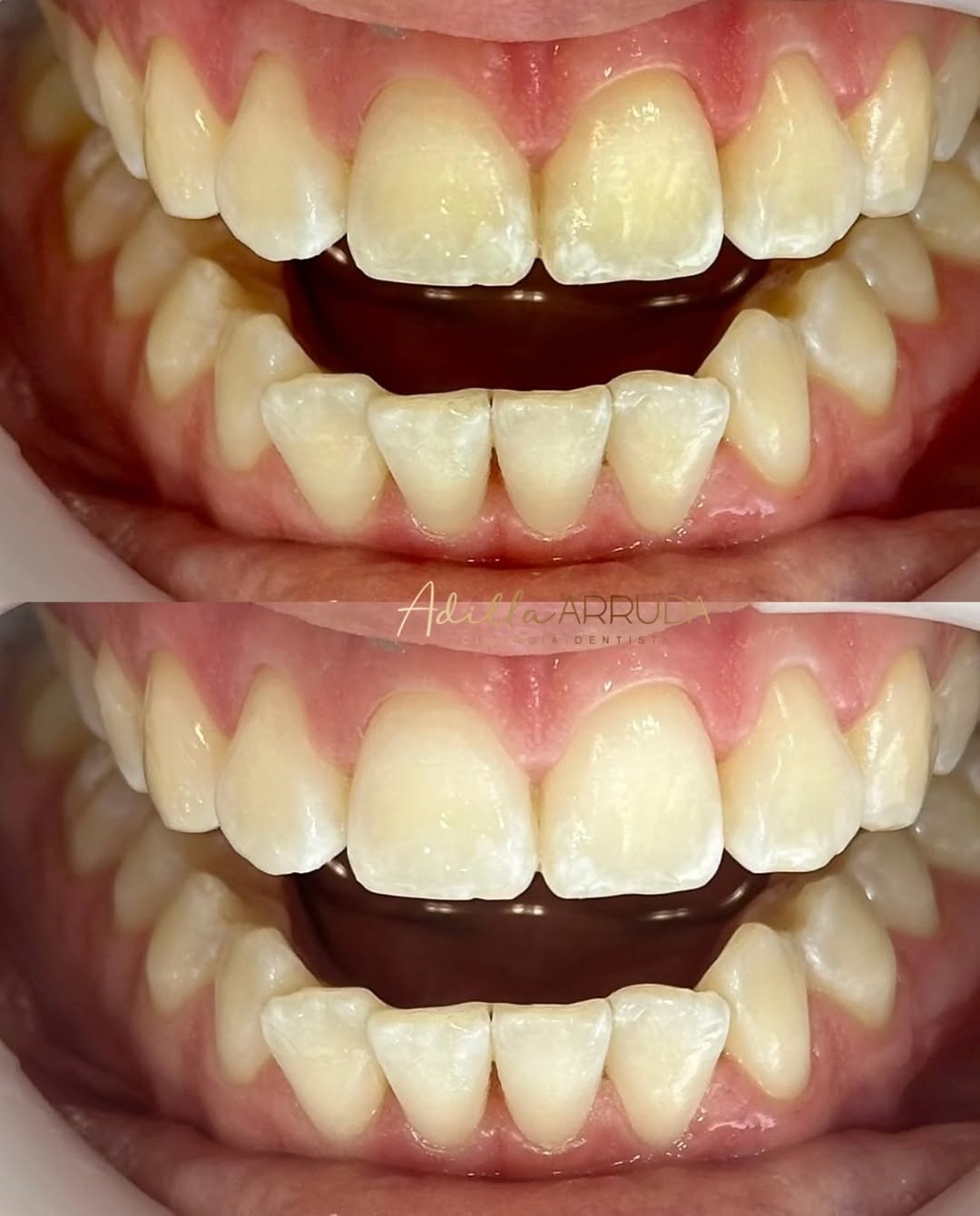 Correção Estética Dental (antes e depois)